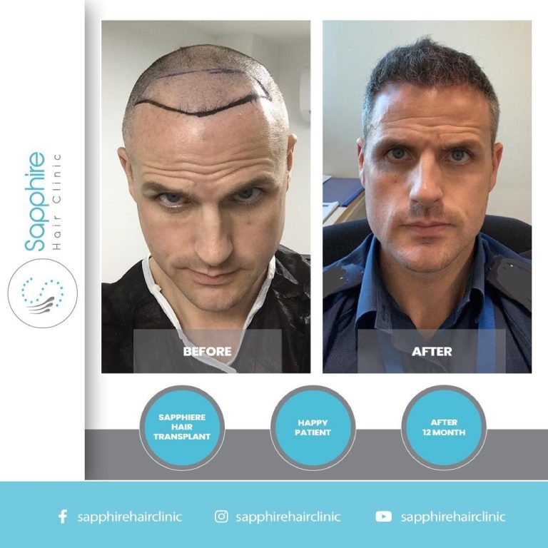 Hair Transplant Istanbul: Natural-Looking Results at Affordable Prices – Sapphire Hair Clinic