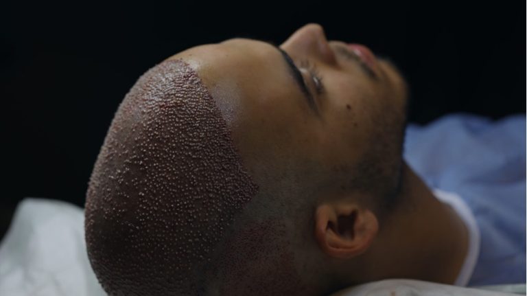 Guide to Finding a Hair Transplant Specialist in Turkey