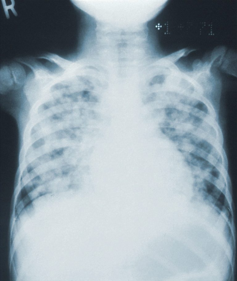 What to Expect During a Lung Cancer Screening