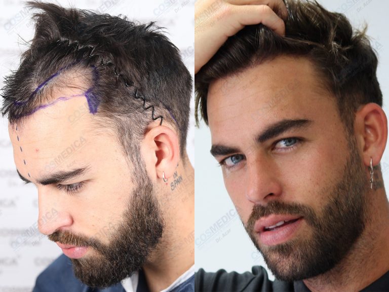 Hair transplants in Turkey: low cost, high quality