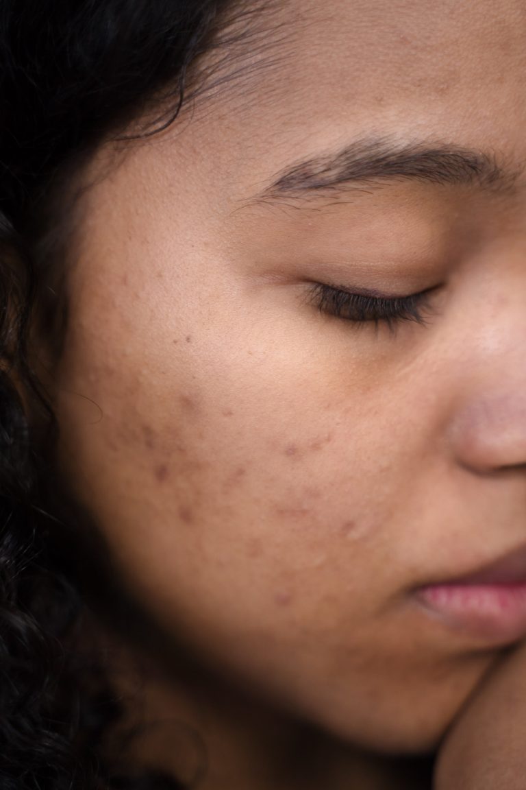 LED Light Therapy: An Effective Treatment for Acne