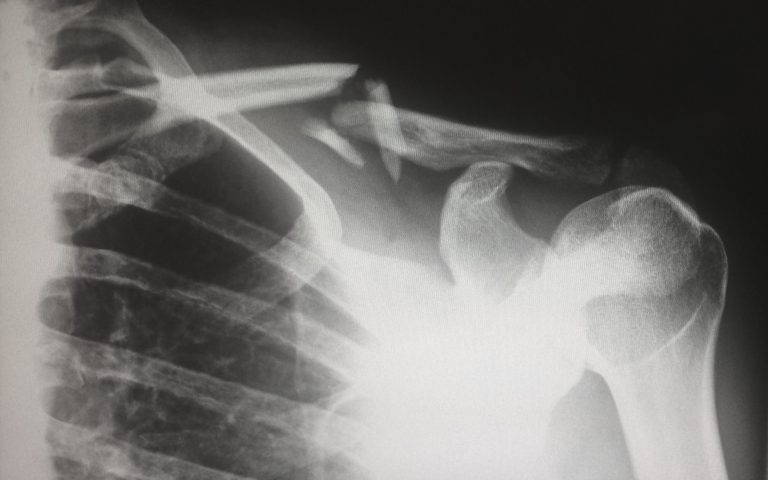 Revolutionising Workplace Recovery: Unveiling the 3 Essential Steps for Swift Rehabilitation from Work Injuries