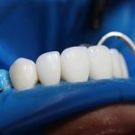 Dental Implants: Do They Look & Feel Like Natural Teeth?