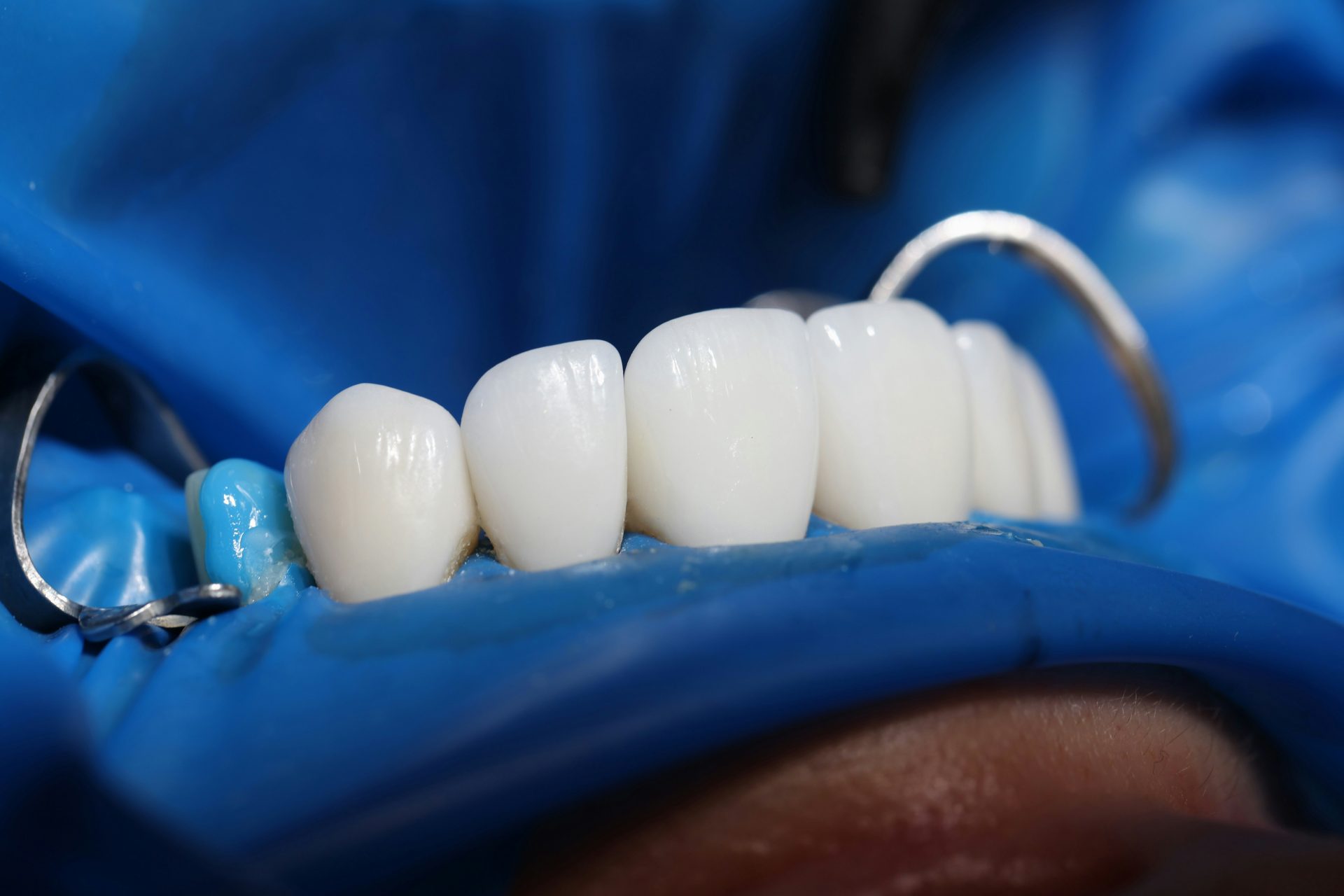 Dental Implants: Do They Look & Feel Like Natural Teeth?