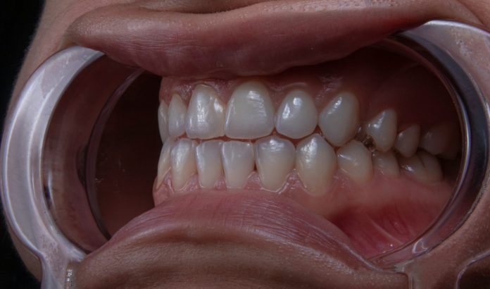 Why Straightening Your Teeth is About More Than Just Looks