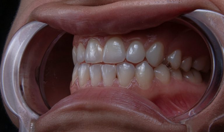 How Can Straightening Your Teeth Improve Both Function and Aesthetics?