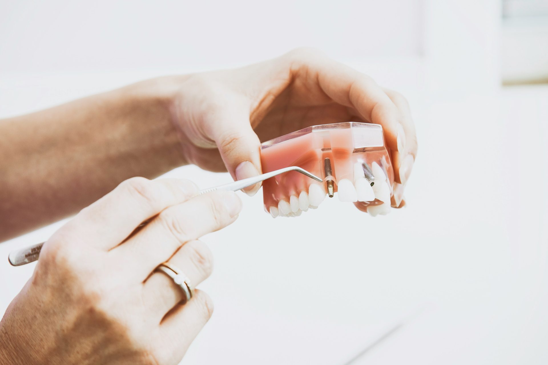 What Are the Benefits of Dental Implants Over Dentures?