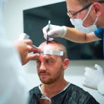 Hair Transplant in Turkey: The 10 Clinics Leading in 2025